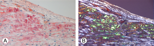 Amyloid & Congo Red